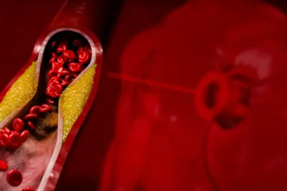 Tiché signály na koži a očiach: Ako spoznať vysoký cholesterol včas?