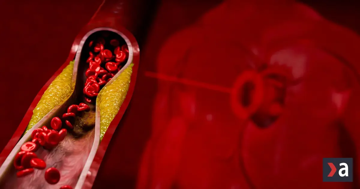 Tiché signály na koži a očiach: Ako spoznať vysoký cholesterol včas?